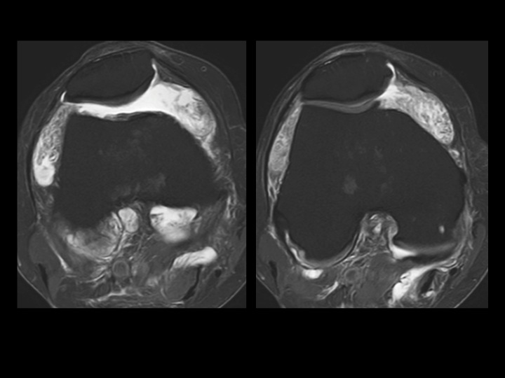 Figure 2 for case Lipoma Arborescens